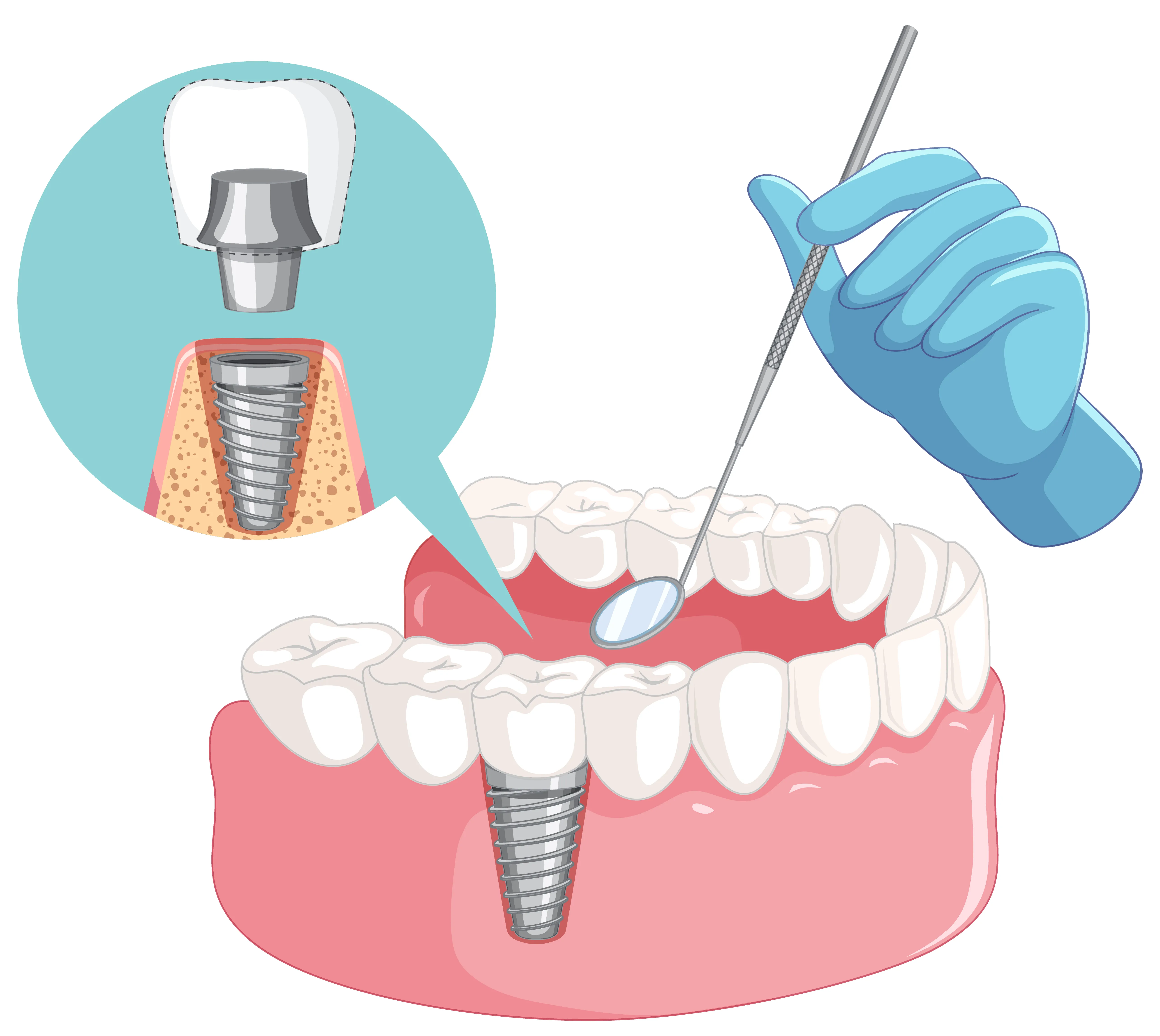 Dental Restoration